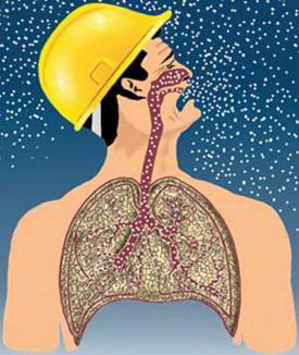 Silicosis_image004
